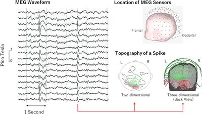 Association Between Magnetoencephalographic Interictal Epileptiform Discharge and Cognitive Function in Young Children With Typical Development and With Autism Spectrum Disorders